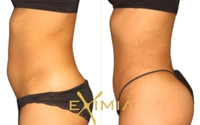 Lose Up to 7 cm in One Session with Eximia Body Contouring at BODY TIME Dubai!